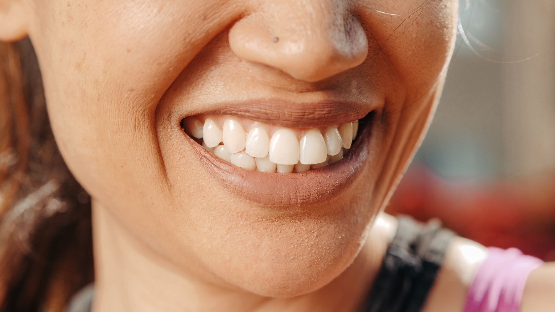 Sorriso natural em tratamento Invisalign